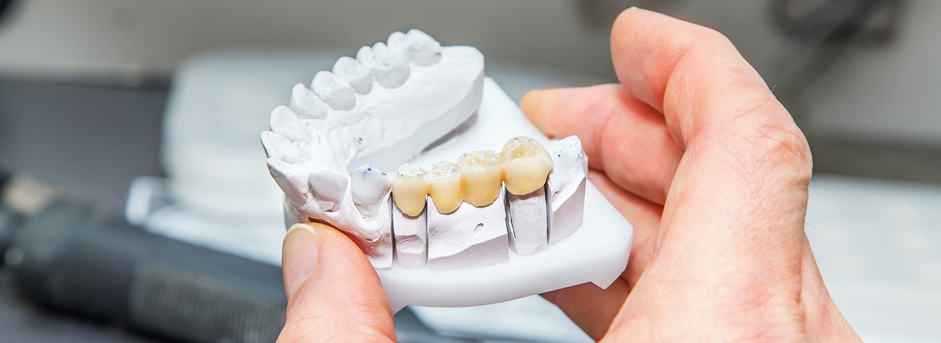 The image shows a person holding a set of dental implants with visible screws, indicating they are either preparing for an installation or demonstrating the components of a dental implant system.
