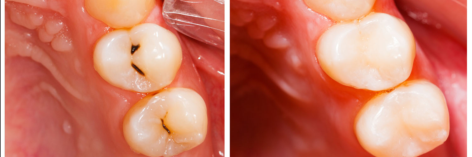 The image shows a close-up of a human mouth with multiple teeth exhibiting significant decay and cavities, indicating poor oral hygiene.