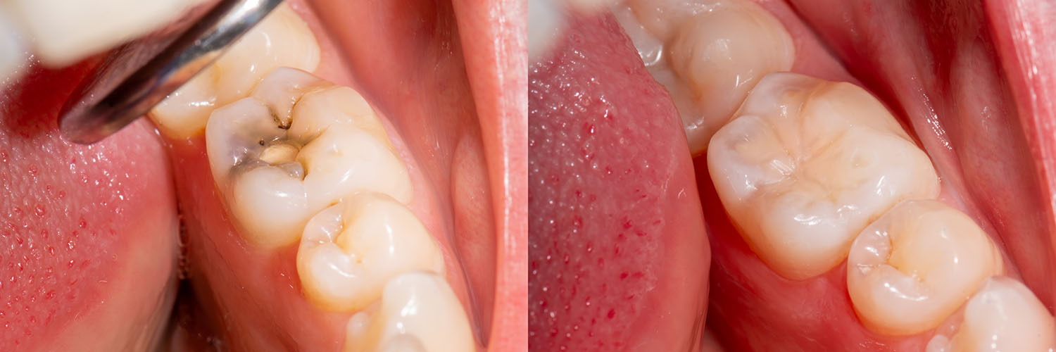 The image shows a close-up view of an open mouth with multiple teeth, including some that appear damaged or decayed, and a visible tongue, set against a blurred background.