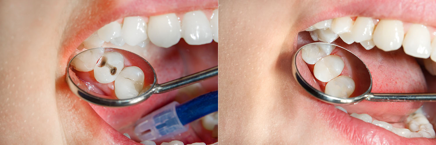 A composite image showing two halves of a smiling mouth with teeth, each half displaying a different perspective of an oral hygiene product being used.