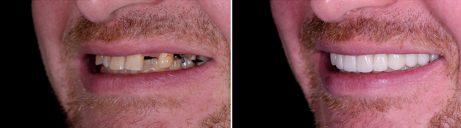The image features a person with a beard smiling, showcasing their teeth before and after dental work.